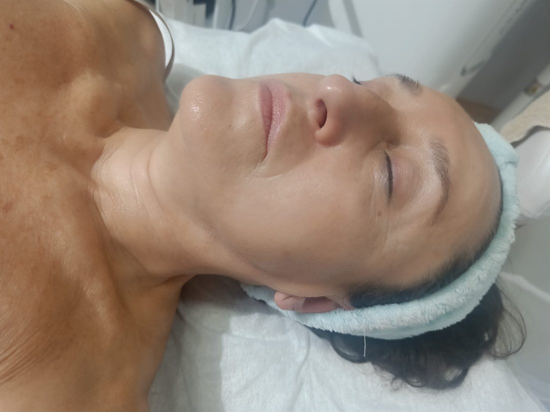 Resultado de tratamiento facial anti-edad