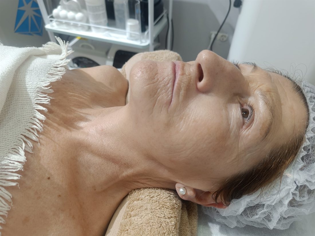 Resultado de tratamiento facial anti-edad combinado