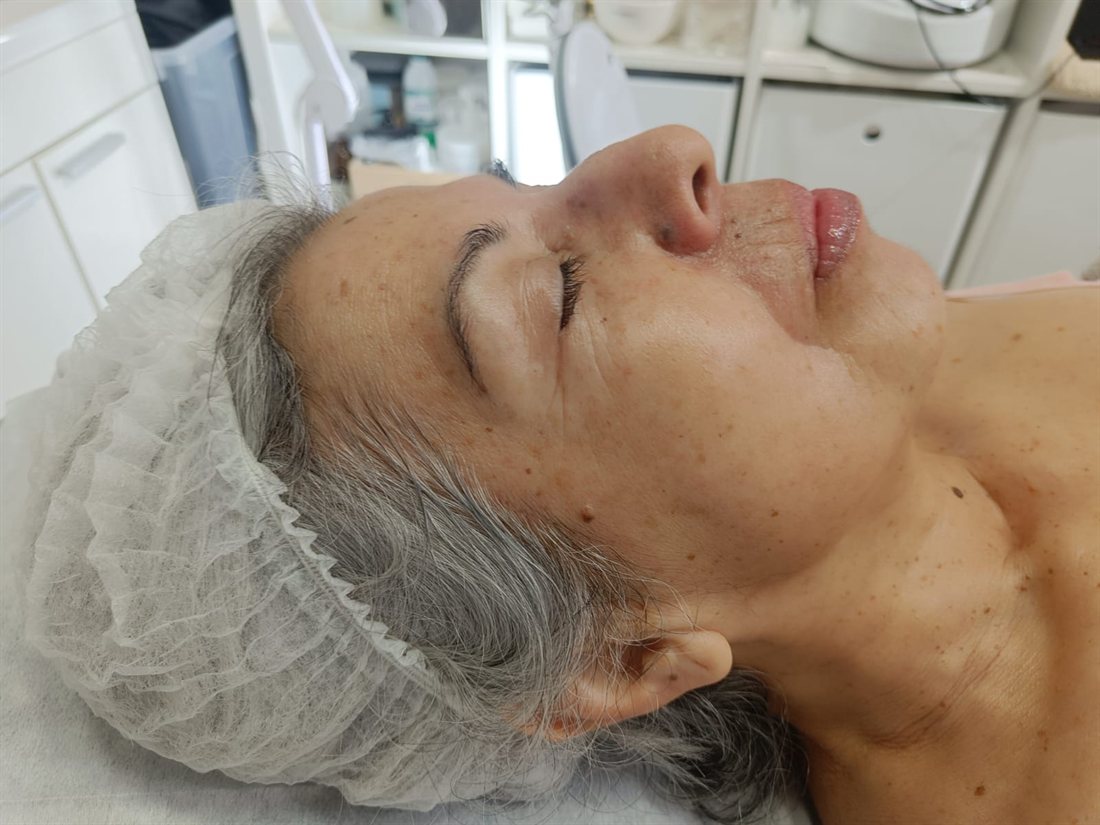 Resultado de radiofrecuencia facial